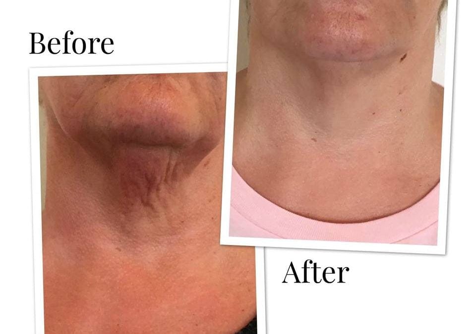 RejuvaMed: Defining the Future of Skin Hydration with Profhilo Treatment - Kinked Press