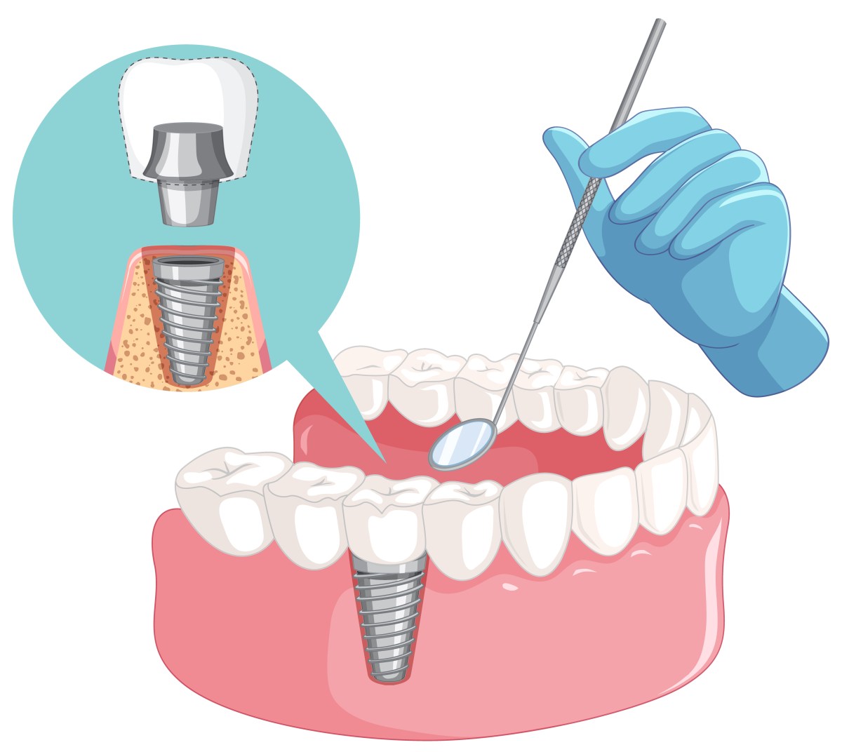 The Ultimate Guide to Tooth Replacement: Crowns, Bridges & Implants Explained – Vibe Writes