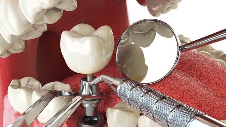 How Permanent Tooth Solutions Improve Smiles and Daily Life | Websyndic