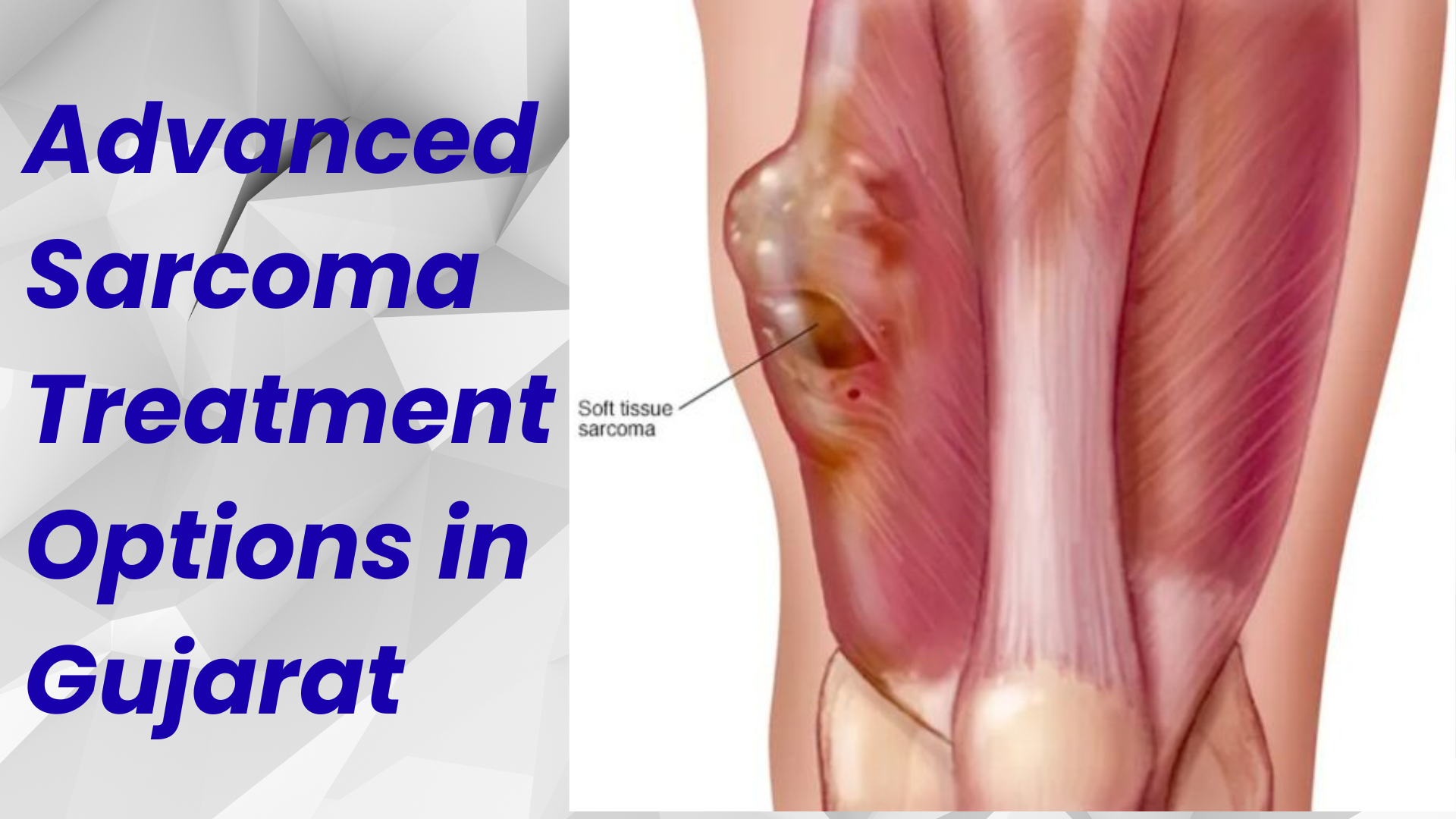 Advanced Sarcoma Treatment in Gujarat | Niramaya Oncology