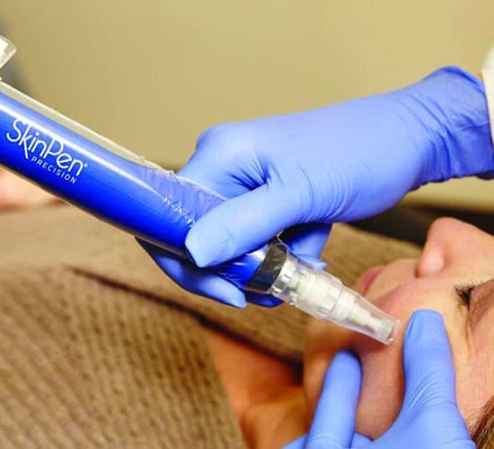 Microneedling Behandling
