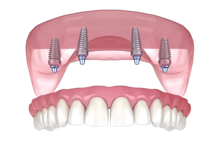Quick Recovery Tips After All-on-4 Dental Implants Placement – BDnews55.com