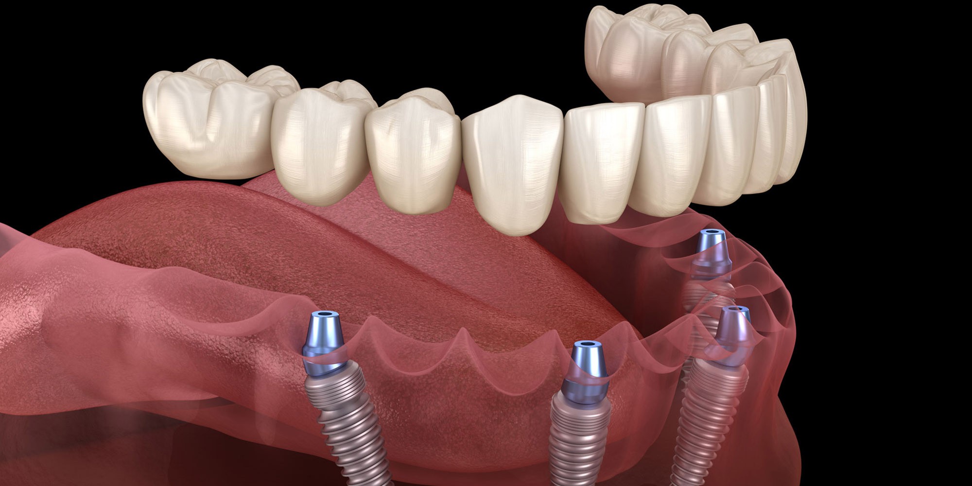Transform Your Smile and Confidence with Full Mouth Dental Implants | Buzzy