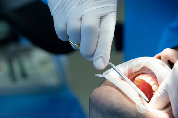 Root Canal FAQs: Everything Patients Ask Before Treatment