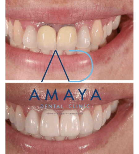 Best Dental Clinic in Bangalore: Amaya Dental