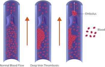 Deep Vein Thrombosis Surgeon | DVT Doctor