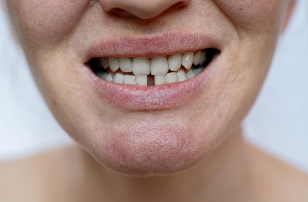 Dental Implants McKinney, TX | Replacement Teeth | Cost of Dental Implants | Marble Dental McKinney