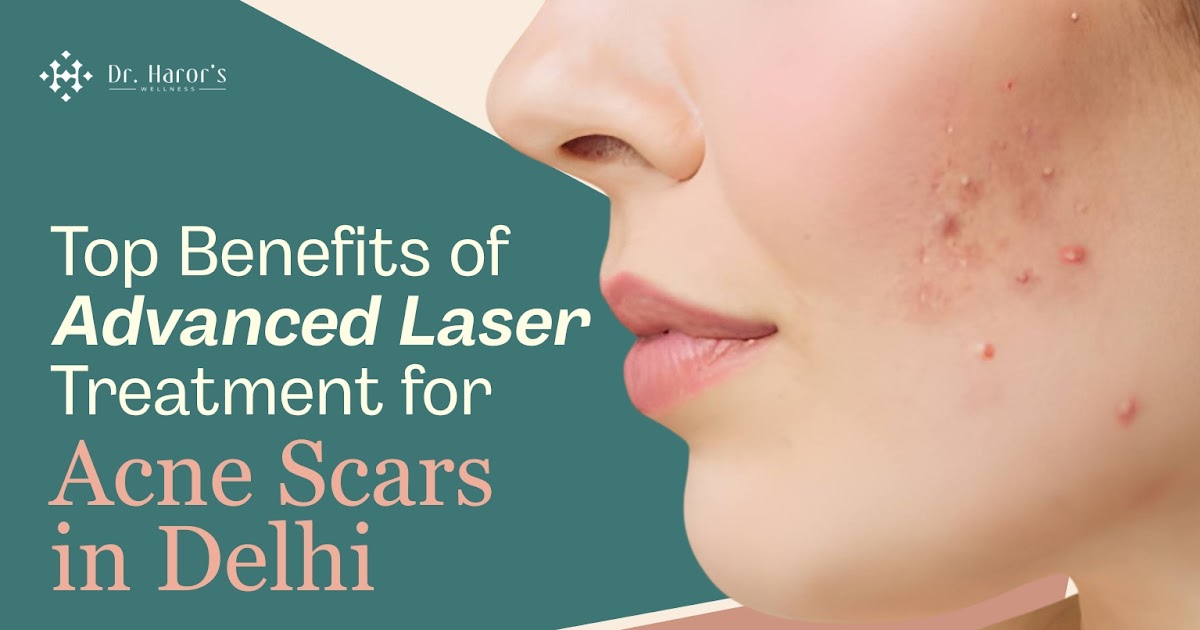 Top Benefits of Advanced Laser Treatment for Acne Scars in Delhi