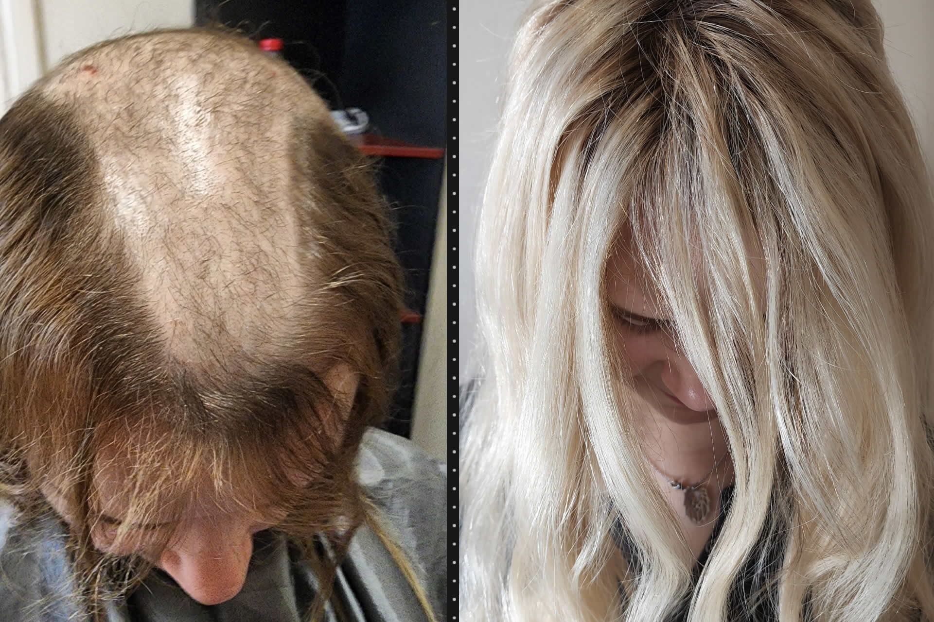 Top-Rated Hair Loss Solutions. Hair Solutions in Sumner, Seattle