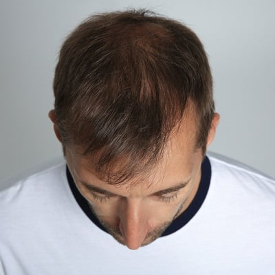 Crown Hair Transplant in Islamabad, Rawalpindi, and Pakistan